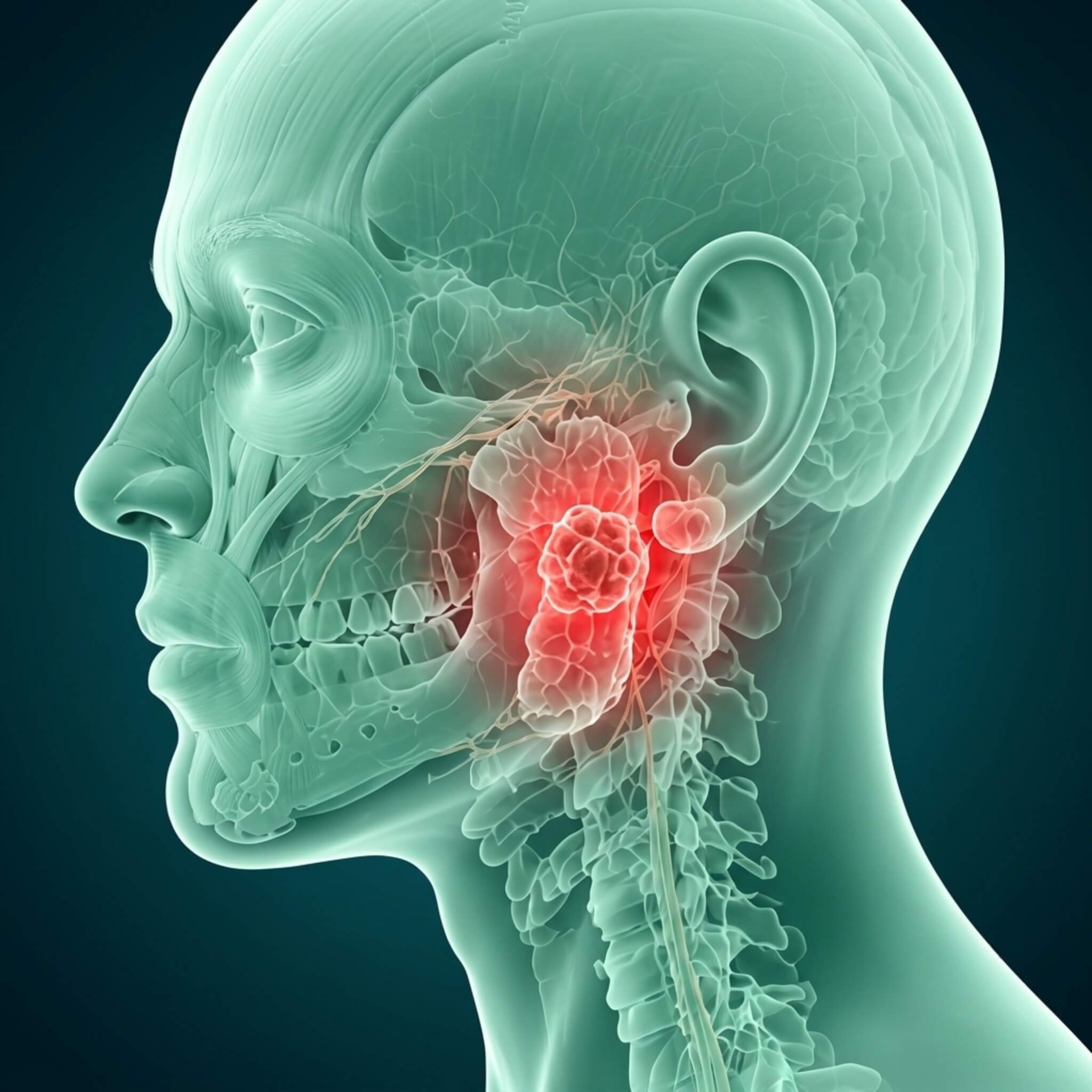 Salivary Gland Tumors - About